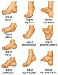 Do you suspect your baby may have clubfoot? Do You Suffer With A Club Foot Put Your Feet In Our Hands