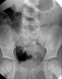 Image result for Voiding Cystourethrogram