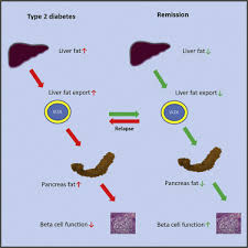 There is one golden rule to effective weight/fat loss, to be in a calorie deficit. Hepatic Lipoprotein Export And Remission Of Human Type 2 Diabetes After Weight Loss Sciencedirect