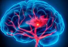 Puede estar provocado por un trombo sanguíneo que tapona una arteria. Herpes Zoster Aumenta El Riesgo De Accidente Cerebrovascular E Infarto De Miocardio Actuamed