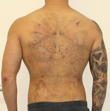 Tattoo removal by size category (e.g., knuckle, hand, sleeve) a flat rate per removal session. Laser Tattoo Removal Progress Photos