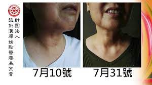 生活中落實原始點 甲狀腺結節也能自然好轉 youtube