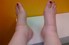 Kaki bengkak semasa mengandung, alahan mengandung, kaki bengkak mengandung 6 bulan, kaki bengkak di awal kehamilan. Cara Menolong Wanita Hamil Dengan Edema Cara Menghilangkan Edema Semasa Kehamilan Rawatan Cara Menanganinya Dan Apa Yang Perlu Dilakukan Pencegahan Edema Semasa Kehamilan