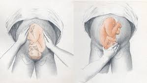 Abnormal Fetal Lie Malpresentation And Malposition Teachmeobgyn