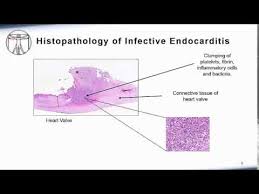 Endocarditis Pathophysiology