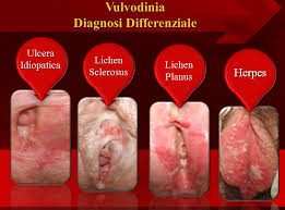 Cos'è e qual è il ruolo della fisioterapia? Flagello Pelvico Ed Al Oscuro Ventre Cause Inoltre Rimedi Dolore Pelvico Centrale De