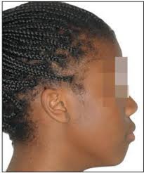 Treatment of a Class 2 biproalveolia in a patient of Burkinabe origin