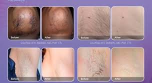 I have recently undergone laser hair removal at saraswat hospital, and my experience has been overwhelming. Laser Hair Removal Treatment Forever Young Spa