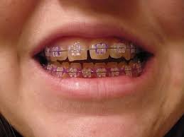 Black And Purple Braces Color Purple Braces Colour Braces Colors Dental Braces Braces Tips