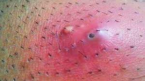 Improper shaving is the leading cause of ingrown hair on scalp on the scalp, ingrown hairs may occur on the back of the head, the forehead and the temple (side of the head) on the top as you have already seen in the pictures above. Ingrown Hair 2019 Best Ingrown Hair Ever Youtube