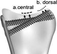 Lateral view of distal radius with a variable-angle volar ...