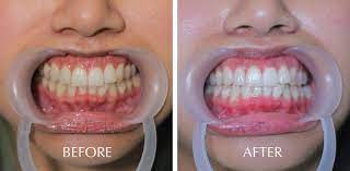 Currently, dentists use scalpels, lasers, and radiosurgery to perform the gum contouring procedure. Cosmetic Dentistry Manila Philippines