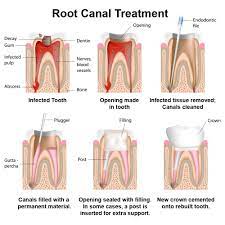 Root canal treatment (also known as endodontic therapy, endodontic treatment, or root canal therapy) is a treatment sequence for the infected pulp of a tooth which is intended to result in the. Root Canal Therapy Recovery Edmonton Ab