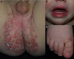 Image result for Hand foot and mouth disease HFMD roof of mouth