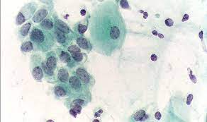 Pap Test Krebsabstrich Des Gebarmutterhalses Netdoktor At