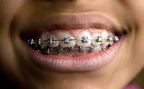 Safer alternatives to diy braces do exist. Inside The Bizarre World Of Do It Yourself Braces