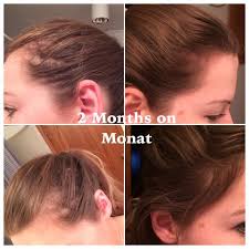 I met lisa* last week. I Have Pcos And My Hair Is Coming Back I Have Started Using The Irt Spray After This Pics Was Taken To Speed It Up A Bit Pcos Hair Loss