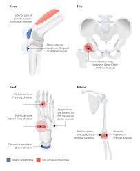 Image result for Pubic Apophysitis