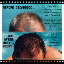 2 top essential oils for thinning hair. Pin On Young Living Essential Oils