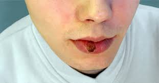 Maybe you would like to learn more about one of these? ØªØ¹Ø±Ù Ø¹Ù„Ù‰ Ù…Ø±Ø§Ø­Ù„ Ù…Ø±Ø¶ Ø§Ù„Ø²Ù‡Ø±ÙŠ ÙˆÙŠØ¨ Ø·Ø¨