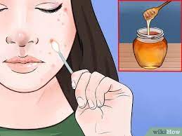 Hey guys i have extreme hair growth. 4 Ways To Remove Ingrown Hair On Your Face Wikihow