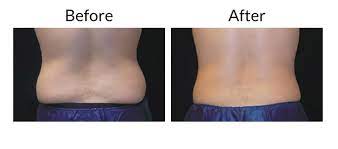 Maybe you would like to learn more about one of these? Coolsculpting Male Before After Bodysculpt Savannah