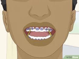 Gently slide it up and down between your teeth. 3 Ways To Wear Braces With Confidence And Style Wikihow