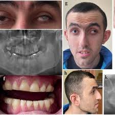 PDF) Nance-Horan Syndrome: Characterization of dental, clinical and  molecular features in three new families