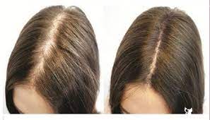 Sac Dokulmesi Thick Hair Remedies Grow Hair Vitamins For Hair Growth