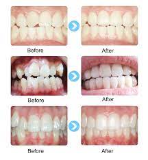 Silicone Teeth Alignment Trainer Mouth Guard Teeth Straightening Teeth Alignment Teeth Braces