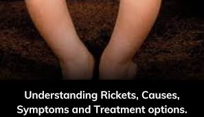 Image result for Rickets