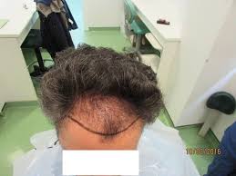 Extragerea grefelor( radacini de par) cu ajutorul unui aparat parul nou implant va continua sa creasca toata viata si nu va mai cadea. Implant De Par Hdc Home Facebook