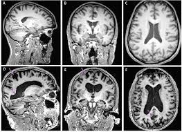 Mri or magnetic resonance imaging uses strong magnetic fields and. Neuroimaging And Alzheimer S Disease Practical Neurology