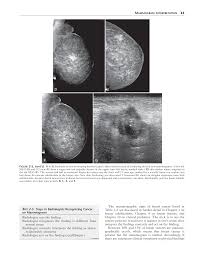 Image result for Mammogram Interpretation
