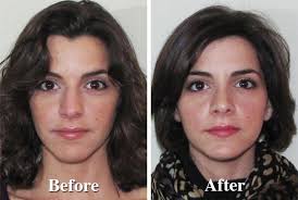 Steroid nasal drops are commonly used to shrink the polyps. Understand Breathing And Sinus Expert Sinus Surgeon Nyc Dr Garrett Bennett Ny Sinus Rhinoplasty Surgeon