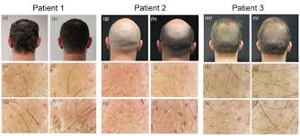 Since the needle size is very small, it can easily work its way into the skin without leaving a large scar on your scalp. The Use Of Microneedling Associated To Photobiomodulation In The Treatment Of Male Androgenetic Alopecia Case Series International Journal Of Case Reports And Images Ijcri