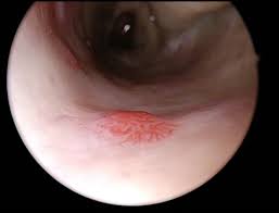 Image result for Epistaxis