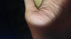 Maybe you would like to learn more about one of these? Red Brown Speckles On Palm Of Hands And Fingers Science For Me