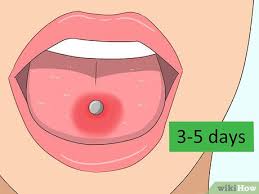 The signs and symptoms of tongue herpes include: 3 Ways To Reduce Tongue Swelling Wikihow