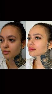 Mandíbula e queixo bem definidos transformam o rosto, realçando sua  harmonia e beleza natural., ⚠️ Agende o seu procedimento pelo link na bio.  ☝️ Dr. Márcio Marques