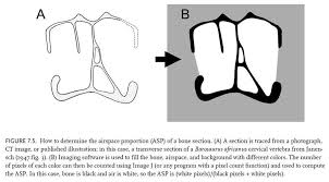 This is a cartoon representation of the structure of bones for my work experience project. Asp Sauropod Vertebra Picture Of The Week