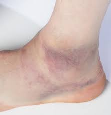 Anfangs treten schmerzen zu beginn der belastung auf und verschwinden nach dem aufwärmen. Fuss Umgeknickt Ursachen Beschwerden Therapie Gesundpedia De