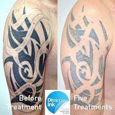 Try to use this cream just before half an hour of your session. Sydney Laser Tattoo Removal Tribal Tattoo On A Bicep One Of Our Most Common