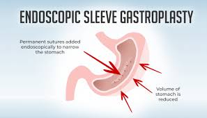 endoscopic sleeve gastroplasty esg
