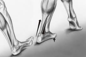 The visa achilles tendon pain questionnaire (download pdf) has been designed to measure progress during rehabilitation. Achilles Tendinitis Mydr Com Au