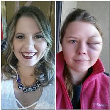 AVM before and after treatment results