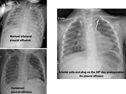 303 385 просмотров 303 тыс. Case 4 2020 Prolonged Time 38 Days Of Bilateral Pleural Effusion After Cavopulmonary Surgery Relieved By Embolization Of Systemic Pulmonary Collateral Vessels In A 40 Month Old Child With Complex Heart Disease