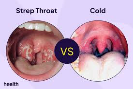 Image result for Strep throat infection roof of mouth