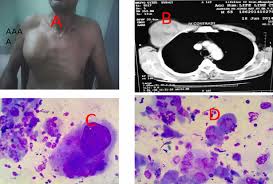 Malignant is an upcoming american horror film directed by james wan from a screenplay by akela cooper, based on an original story by wan, ingrid bisu, and cooper. Malignant Fibrous Histiocytoma Causes Symptoms Diagnosis Treatment Prognosis