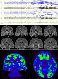 The role of hybrid FDG-PET/MRI